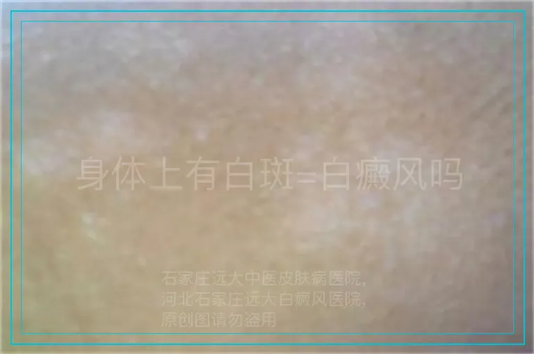 身体上有白斑=白癜风吗