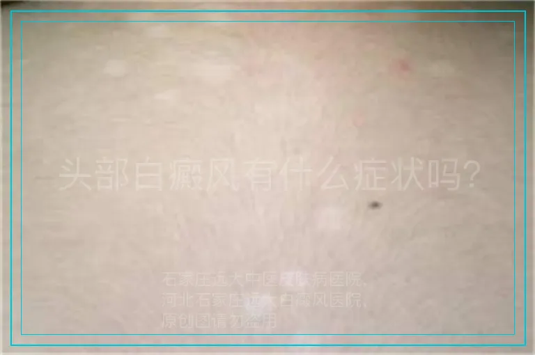 头部白癜风有什么症状吗？