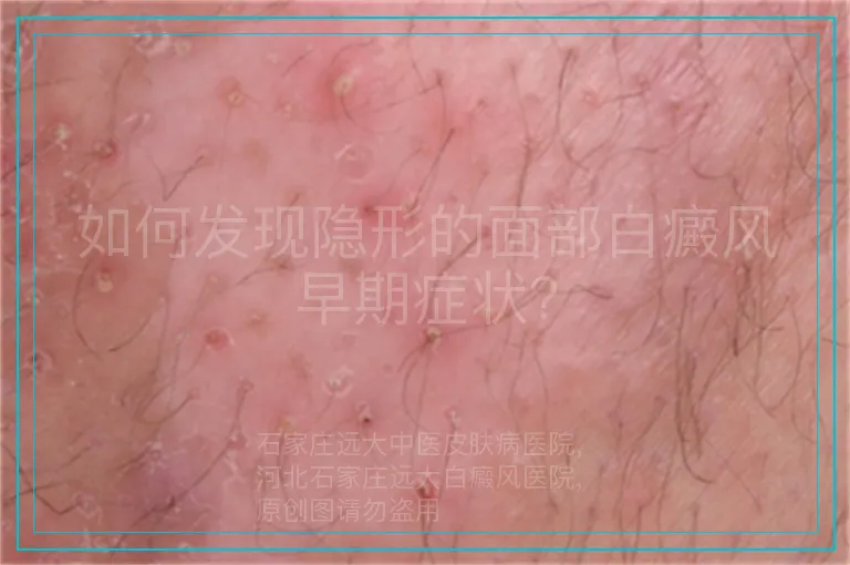 如何发现隐形的面部白癜风早期症状？