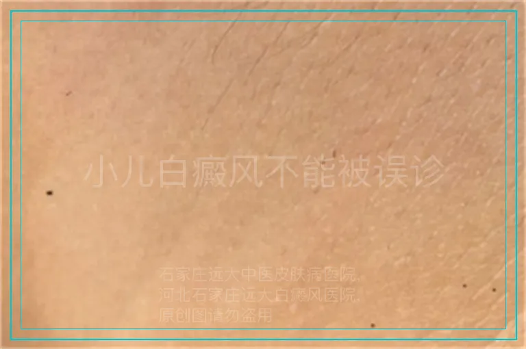 小儿白癜风不能被误诊