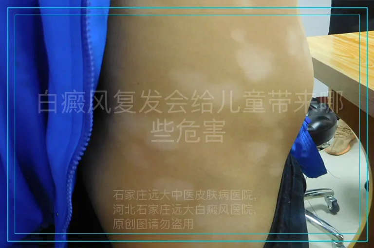 白癜风复发会给儿童带来哪些危害