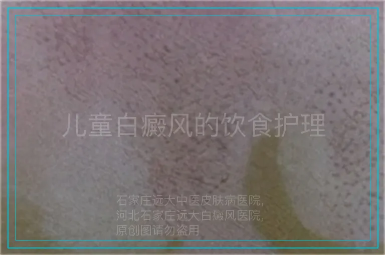 儿童白癜风的饮食护理