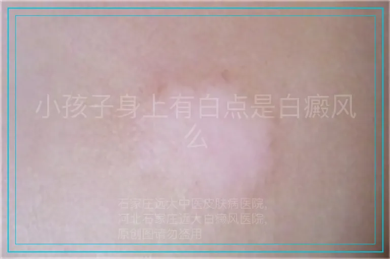 小孩子身上有白点是白癜风么