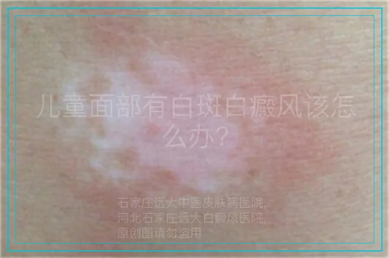儿童面部有白斑白癜风该怎么办?