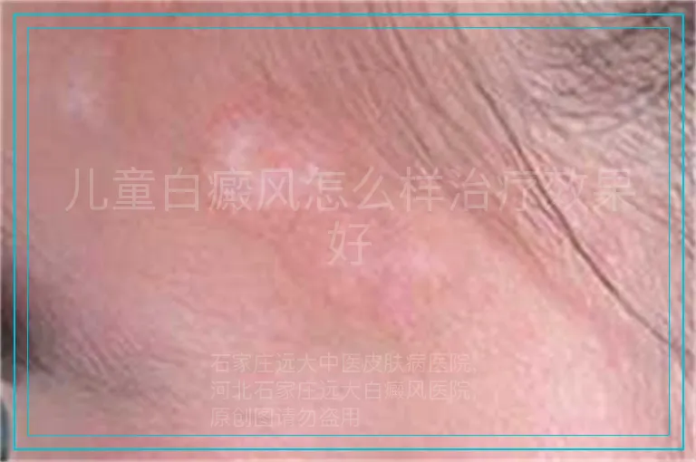 儿童白癜风怎么样治疗效果好