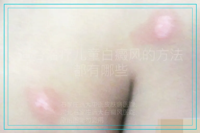适合治疗儿童白癜风的方法都有哪些