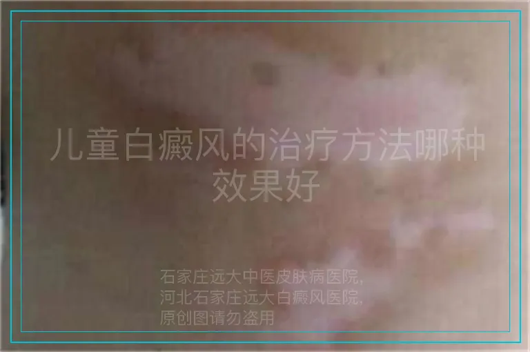 儿童白癜风的治疗方法哪种效果好