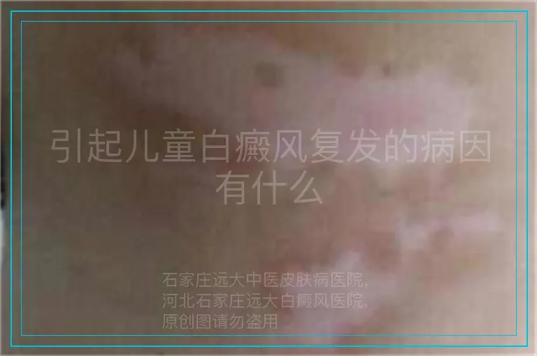 引起儿童白癜风复发的病因有什么