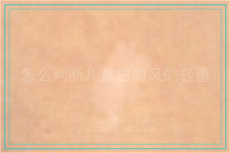 怎么判断儿童白癜风的轻重