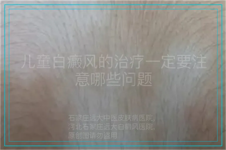 儿童白癜风的治疗一定要注意哪些问题