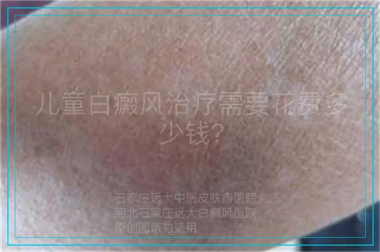 儿童白癜风治疗需要花费多少钱?