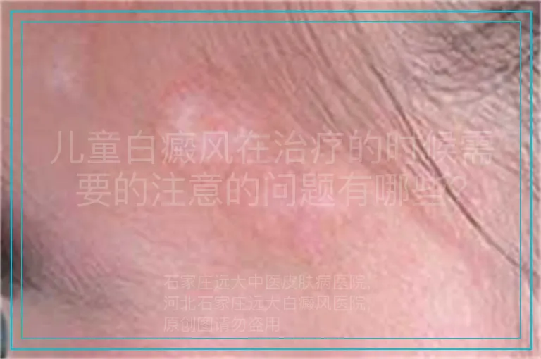 儿童白癜风在治疗的时候需要的注意的问题有哪些?