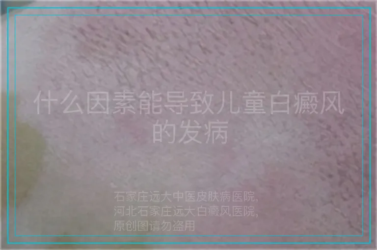 什么因素能导致儿童白癜风的发病