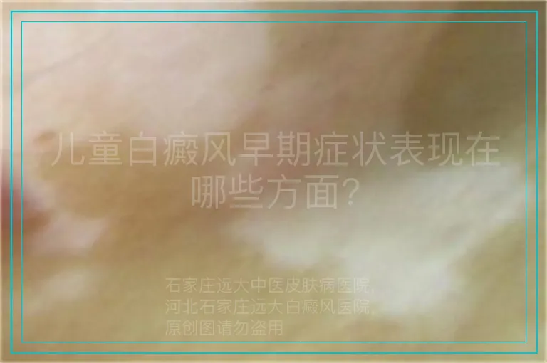 儿童白癜风早期症状表现在哪些方面?