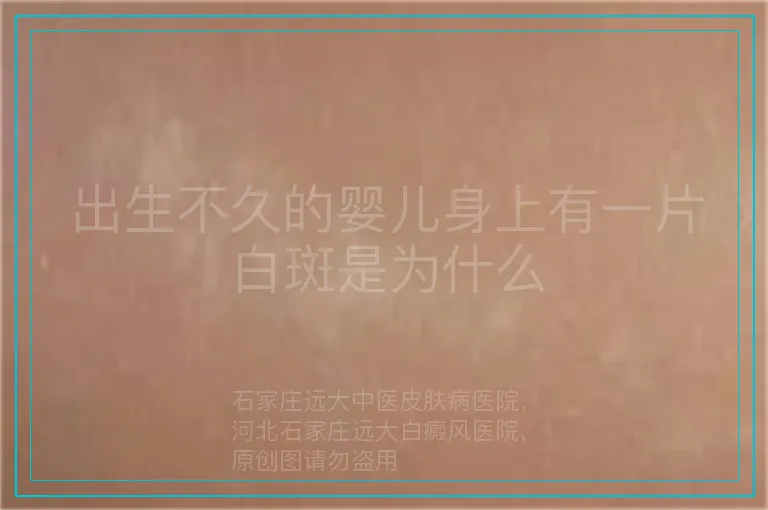 出生不久的婴儿身上有一片白斑是为什么