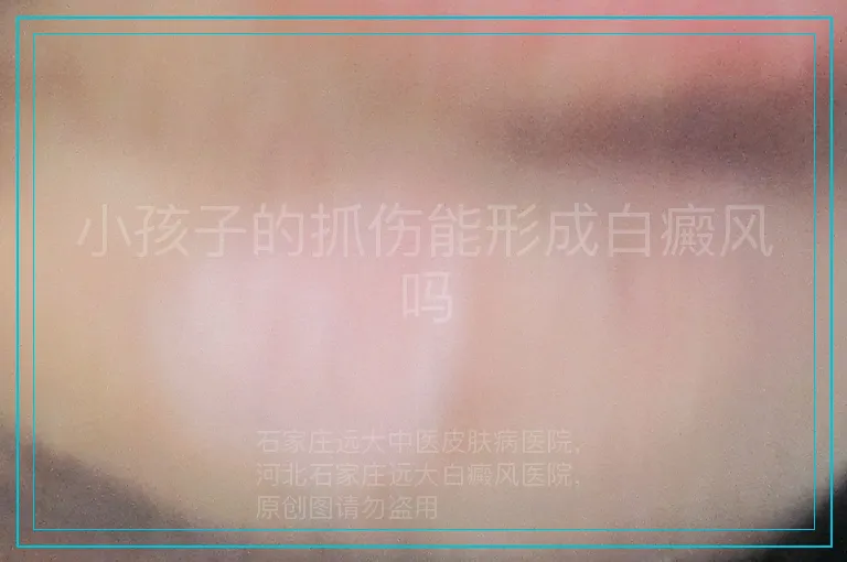 小孩子的抓伤能形成白癜风吗