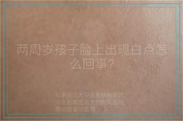 两周岁孩子脸上出现白点怎么回事?
