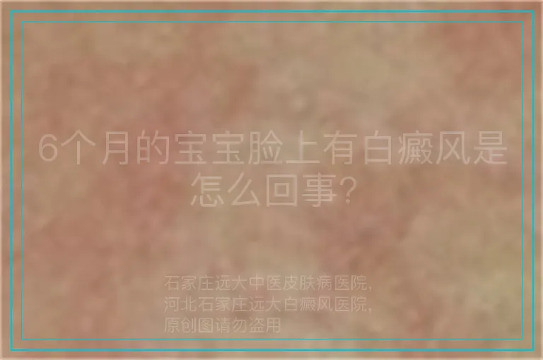 6个月的宝宝脸上有白癜风是怎么回事?