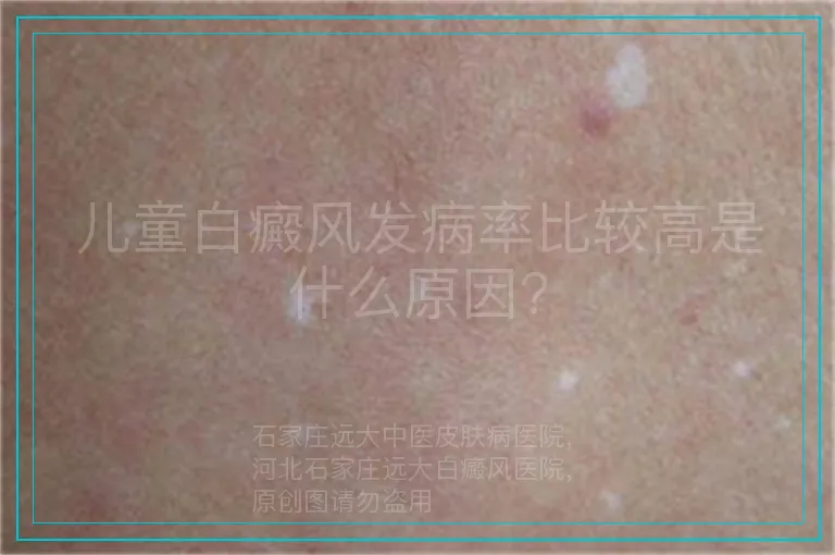 儿童白癜风发病率比较高是什么原因?