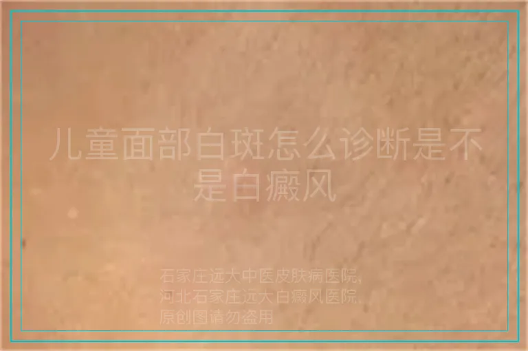 儿童面部白斑怎么诊断是不是白癜风