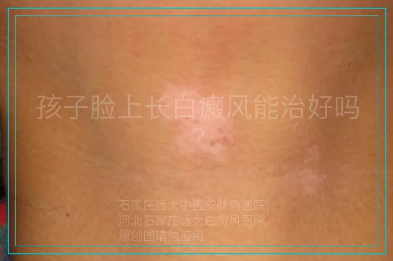 孩子脸上长白癜风能治好吗?
