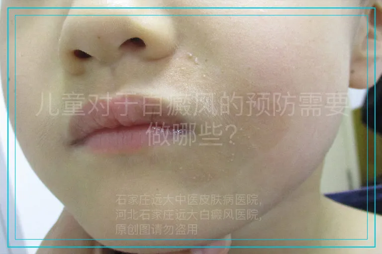 儿童对于白癜风的预防需要做哪些?
