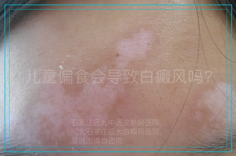 儿童偏食会导致白癜风吗?
