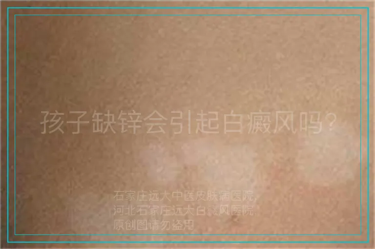 孩子缺锌会引起白癜风吗?