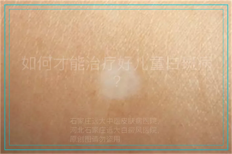 如何才能治疗好儿童白斑病?