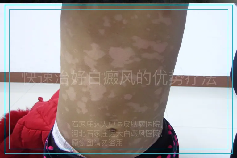 快速治好白癜风的优势疗法