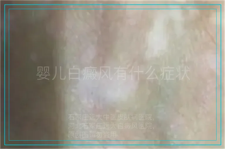 婴儿白癜风有什么症状