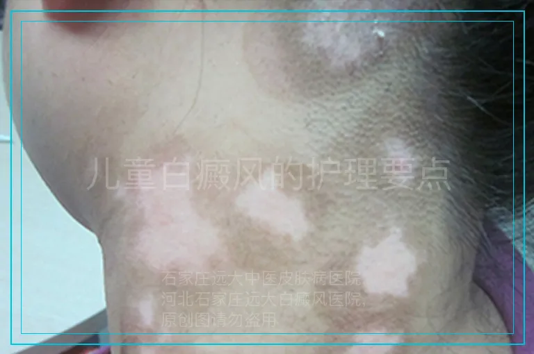 儿童白癜风的护理要点