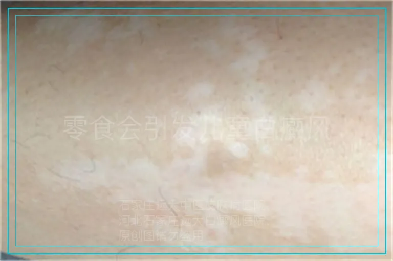 零食会引发儿童白癜风