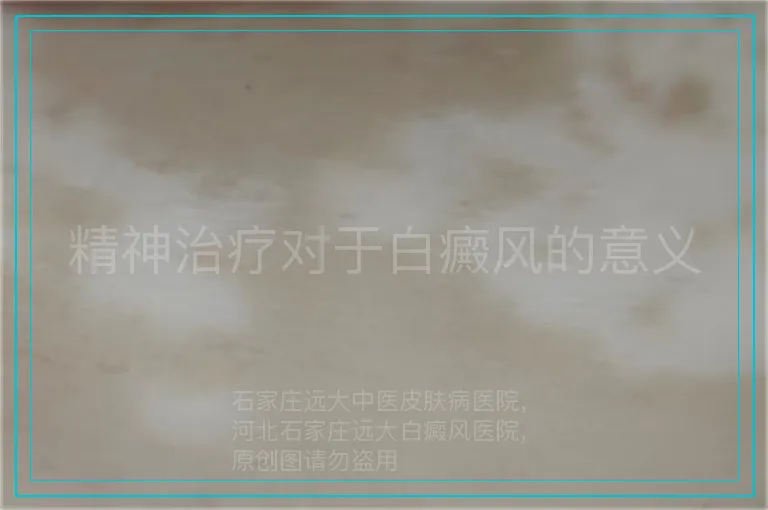 精神治疗对于白癜风的意义