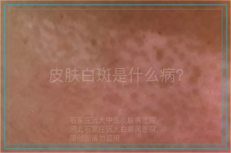 皮肤白斑是什么病？