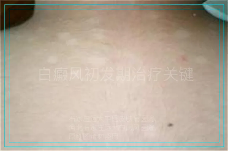 白癜风初发期治疗关键