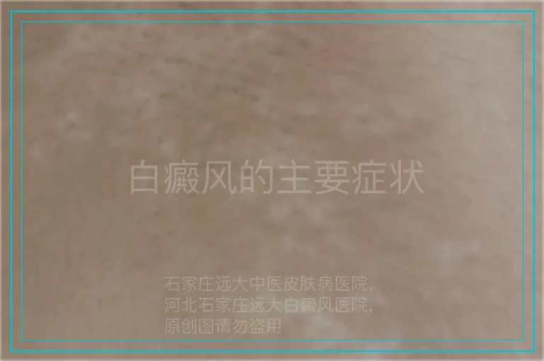 白癜风的主要症状