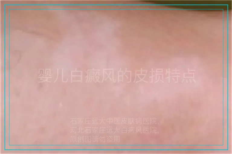 婴儿白癜风的皮损特点