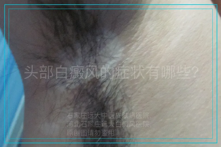 头部白癜风的症状有哪些？