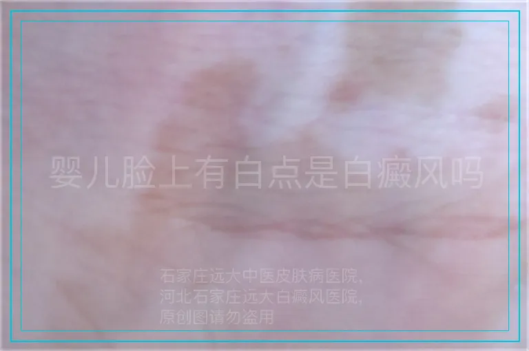 婴儿脸上有白点是白癜风吗