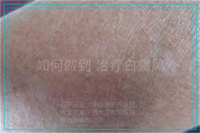 如何做到 治疗白癜风