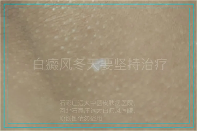 白癜风冬天要坚持治疗