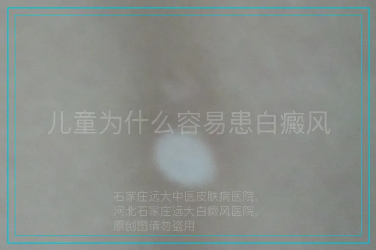 儿童为什么容易患白癜风