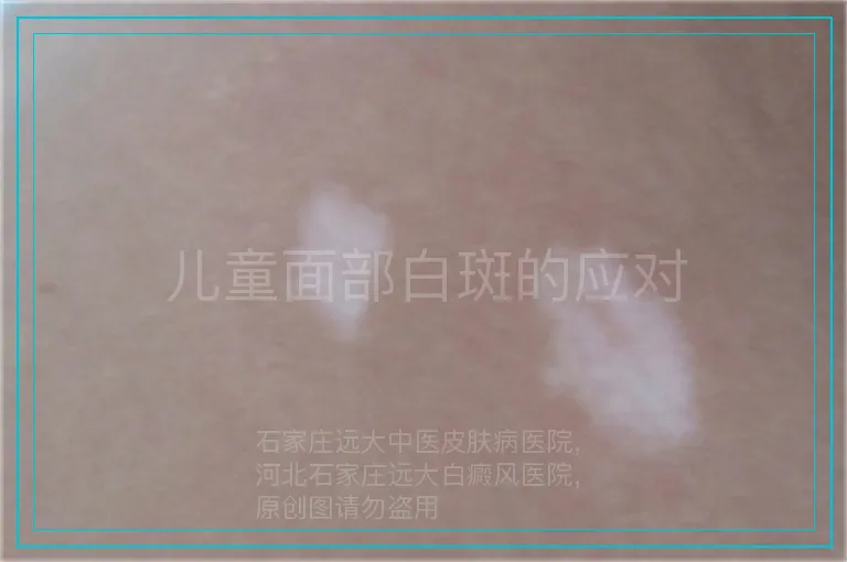 儿童面部白斑的应对