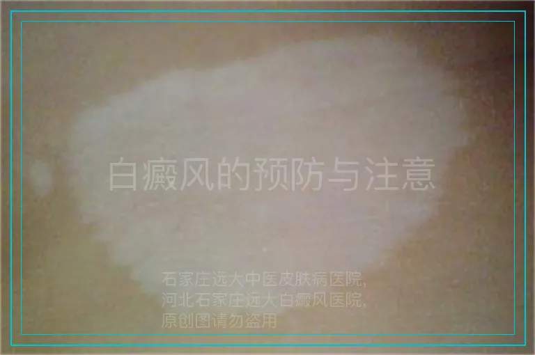 白癜风的预防与注意