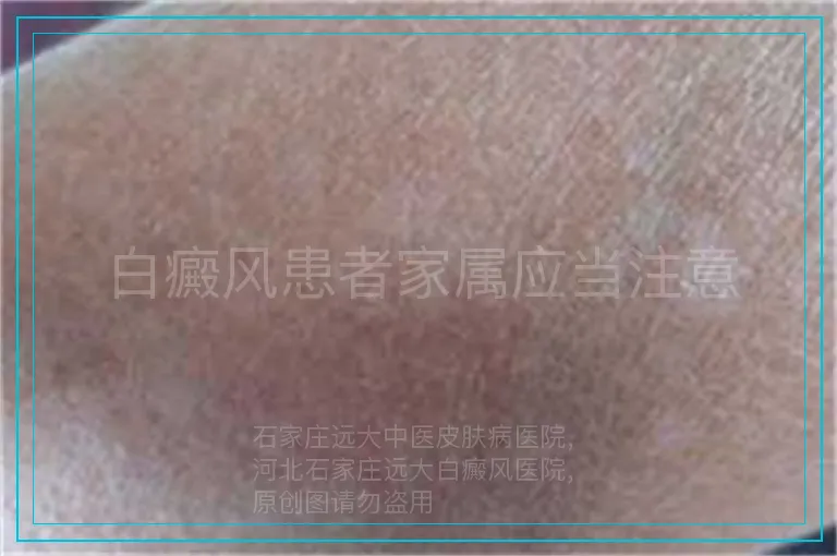 白癜风患者家属应当注意