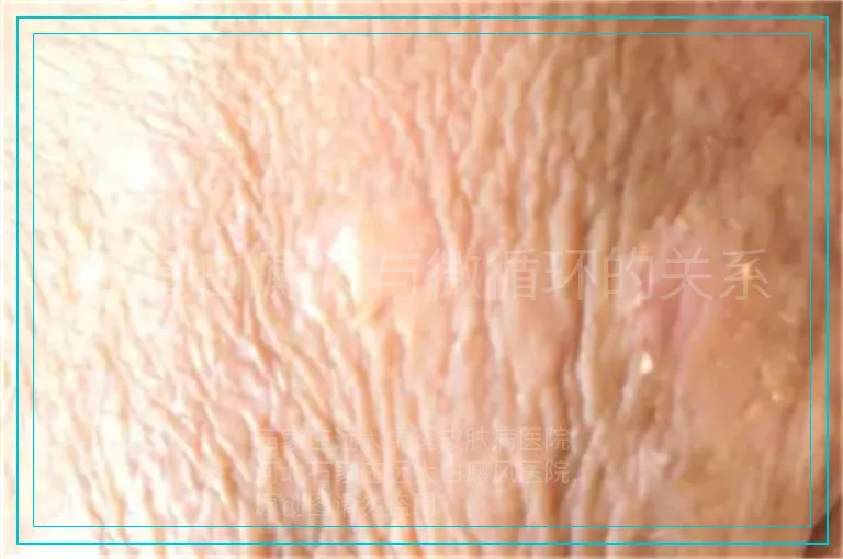 儿童白癜风与微循环的关系