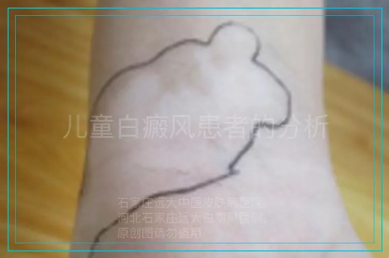 儿童白癜风患者的分析