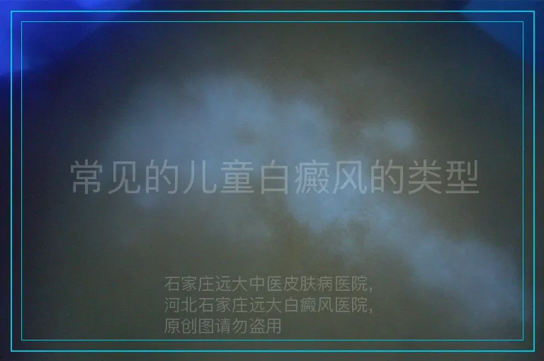 常见的儿童白癜风的类型
