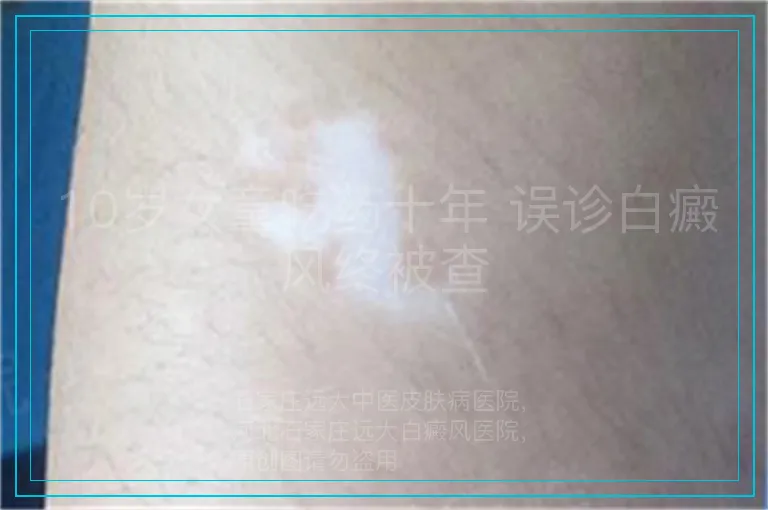 10岁女童吃药十年 误诊白癜风终被查